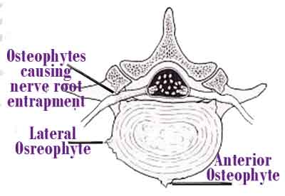 OSTEOPHYTES